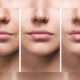 Lips Augmentation Service - Isabella Mia Skincare