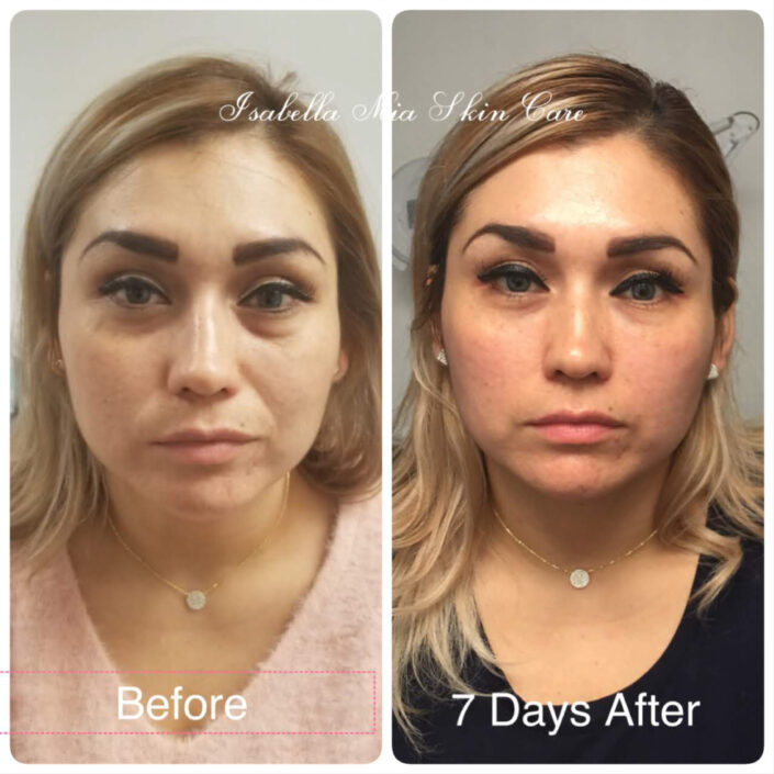 vampire-face-lift - Isabella Mia Skincare