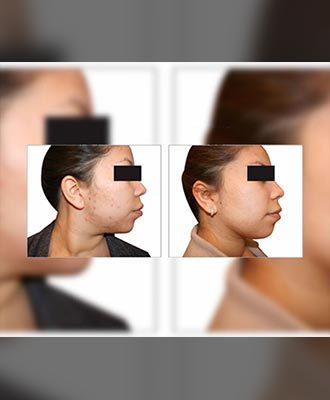 IPL-Acne-Treatment-Isabella-Mia-Skincare