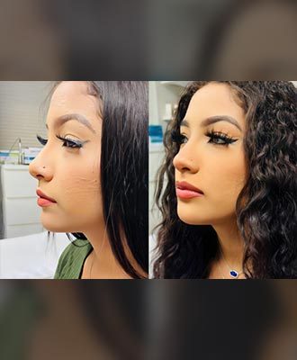 Lips-Augmentation-Isabella-Mia-Skincare