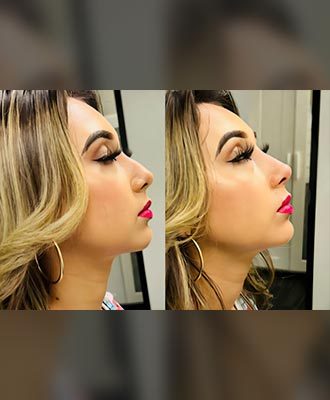 Non-Surgical-Rhinoplasty-Isabella-Mia-Skincare