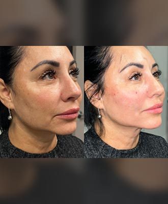 PDO-Thread-Treatment-Isabella-Mia-Skincare