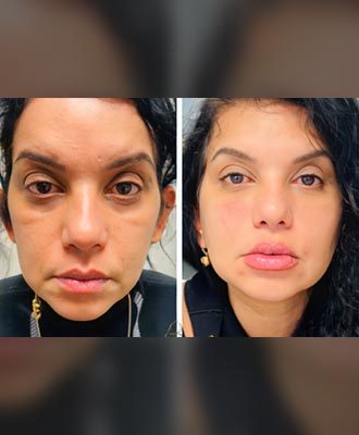 Plasma-Face-Lift-Isabella-Mia-Skincare